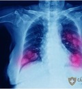 Thuốc chống ung thư phổi di căn