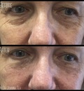 Under Eye Wrinkle Treatments - Dermedica