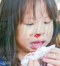 Nguyên nhân gây chảy máu mũi vào ban đêm ở trẻ em?