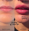 lip filler injections